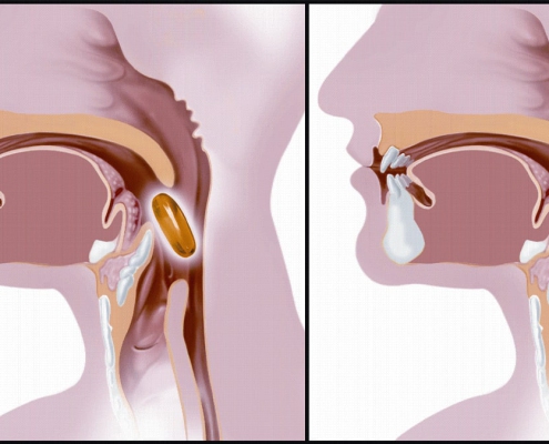 اختلال بلع چیست؟
