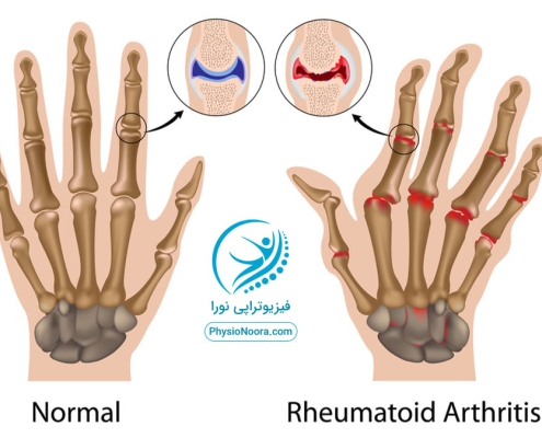 فیزیوتراپی روماتیسم